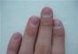 Подногтевой панариций: лечение воспаления Гной под ногтем на большом