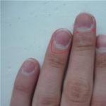 Subunguaal panaritium: behandeling van ontstekingen Pus onder de nagel aan de grote kant