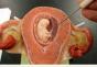 edematous placenta ምንድን ነው