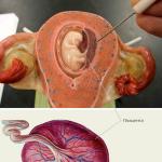 What is edematous placenta